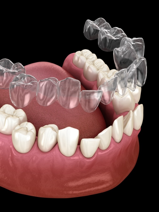 Animated Invisalign tray being placed over a row of crooked teeth