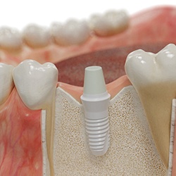 Model of a dental implant in Cary, NC in the jawbone