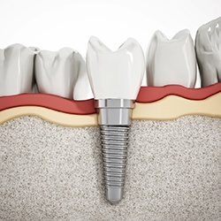 Illustration of a single dental implant in Cary, NC with a crown