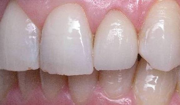 Close up of smile after fixing misshapen tooth
