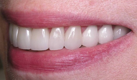 Smile with flawless even teeth after treatment from Cary cosmetic dentist