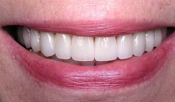 Smile with bright white teeth