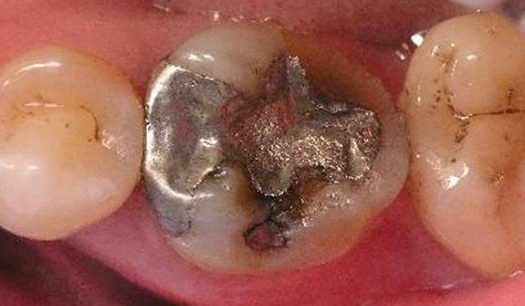 Close up of tooth with dark gray metal dental restoration
