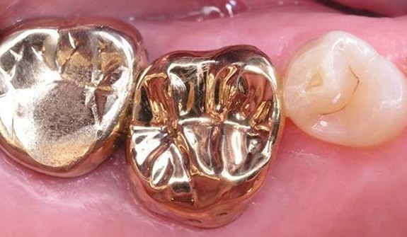 Close up of teeth with brand new gold dental crowns in Cary