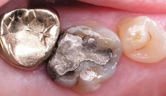 Close up of teeth with old gray dental crowns