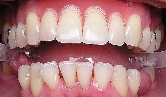 Close up of flawless teeth after cosmetic dental bonding in Cary
