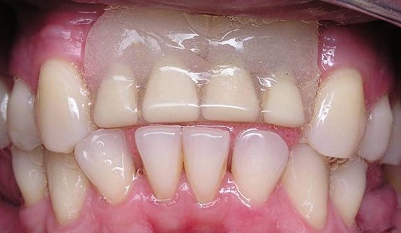 Close up of imperfect teeth before cosmetic dental bonding in Cary