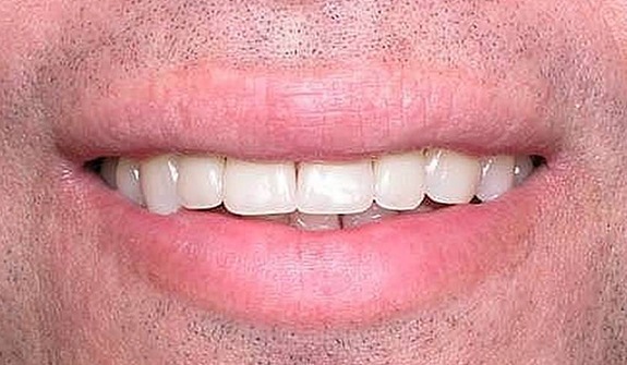 Close up of man smiling with normal sized teeth