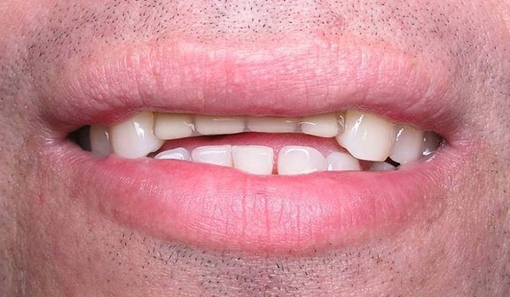 Close up of man smiling with short teeth