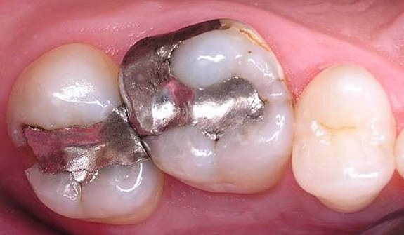 Close up of teeth with gray metal dental restorations