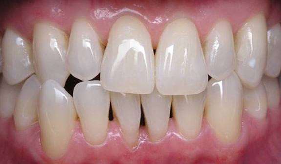 Close up of smile after teeth whitening