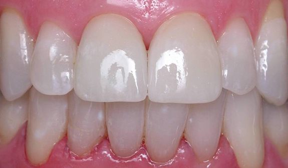 Close up of smile after teeth whitening