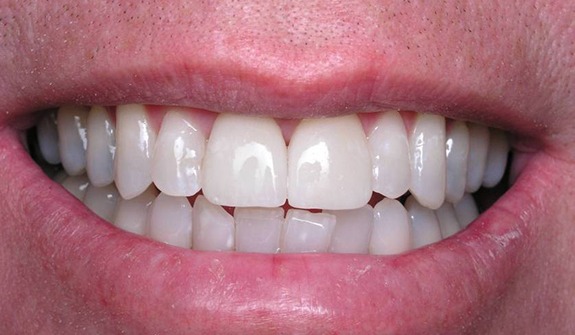 Close up of smile after teeth whitening