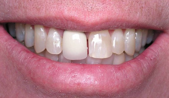 Close up of smile before teeth whitening