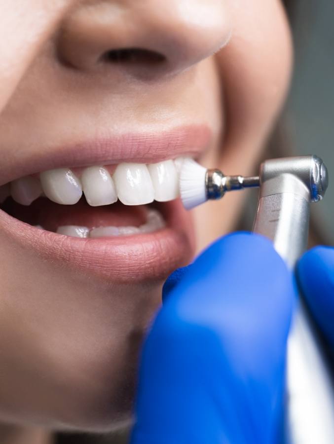 Close up of smile receiving a professional teeth cleaning