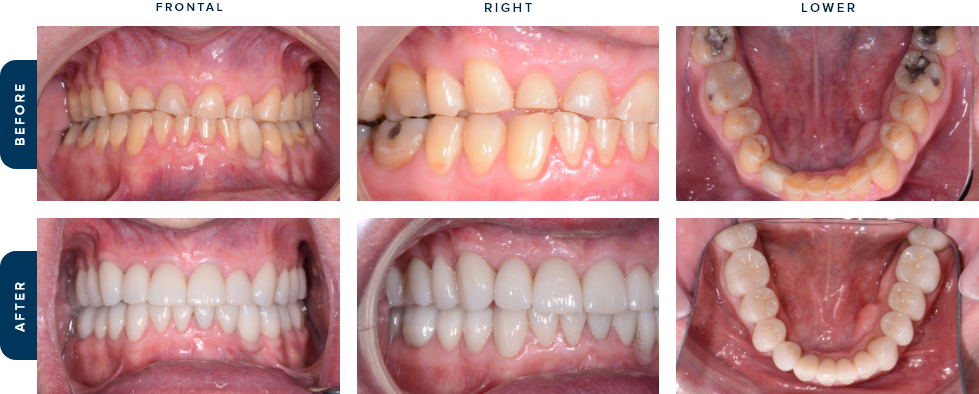 Close up photos of teeth before and after cosmetic dental treatment in Cary