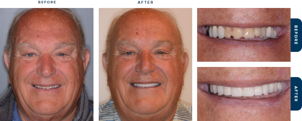 Dental patient smiling before and after dental treatment