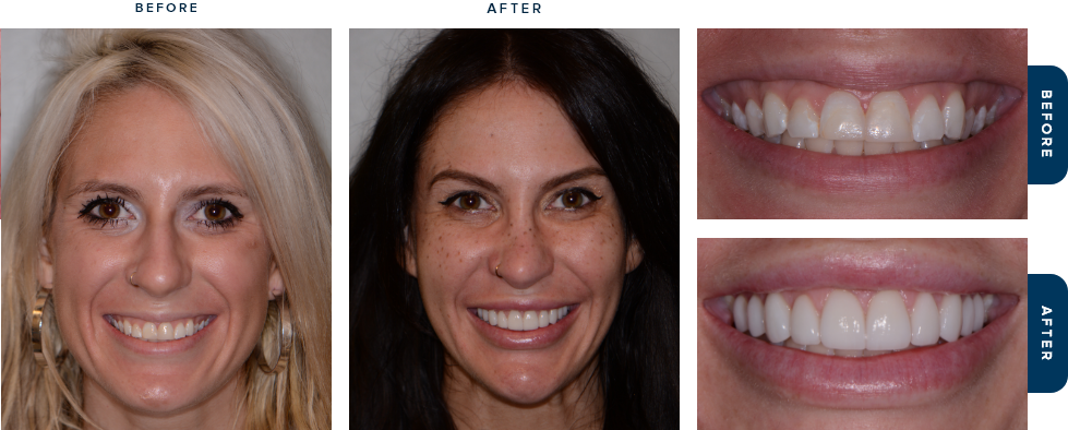 Dental patient smiling before and after dental treatment