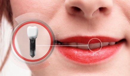 Close up of woman with dental implant smiling