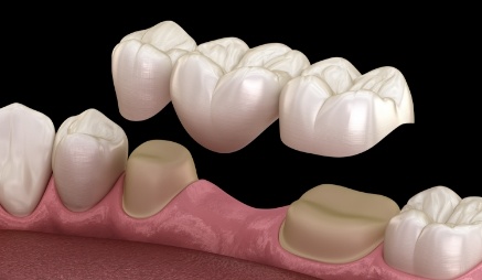 Animated dental bridge replacing a missing tooth