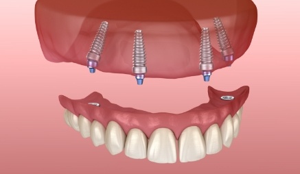 Animated All on 4 implant denture replacing a full row of teeth