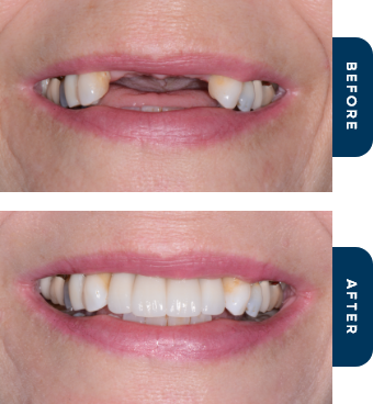 Close up of mouth before and after replacing missing teeth with dental implants in Cary