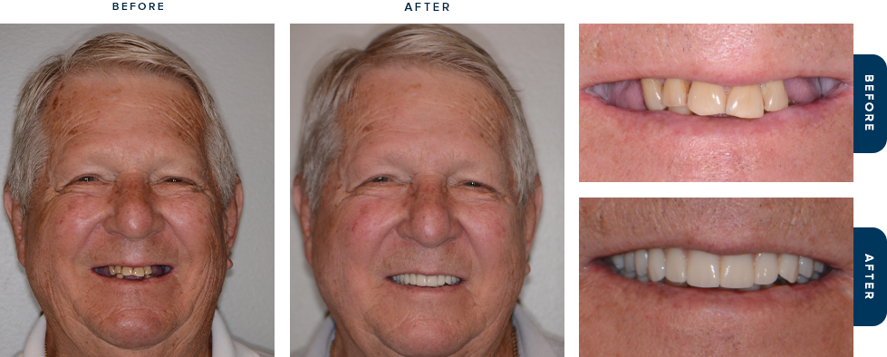 Man smiling before and after replacing missing teeth with dental implants in Cary