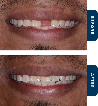 Man smiling before and after replacing missing teeth with dental implants in Cary