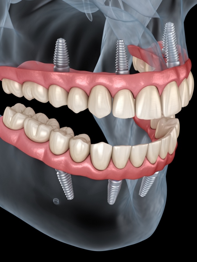 Animated implant dentures replacing both arches of teeth