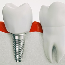 Illustration of tooth and dental implant in Cary, NC