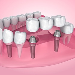 Illustration of dental bridge and dental implants in Cary, NC