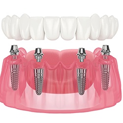 Illustration of dentures and dental implants in Cary, NC