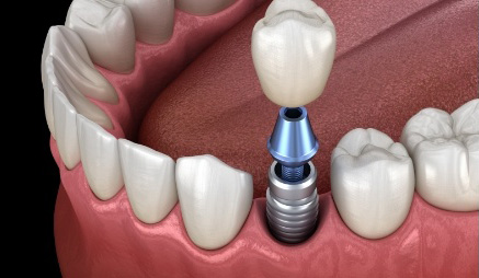Animated dental implant with dental crown replacing one missing tooth