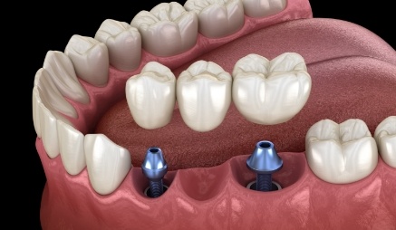 Two animated dental implants with dental bridge replacing three missing teeth