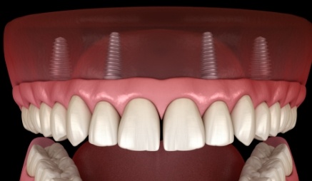 Animated implant denture replacing a row of missing teeth