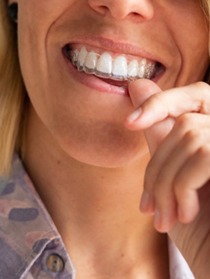 woman putting Invisalign aligner in her mouth