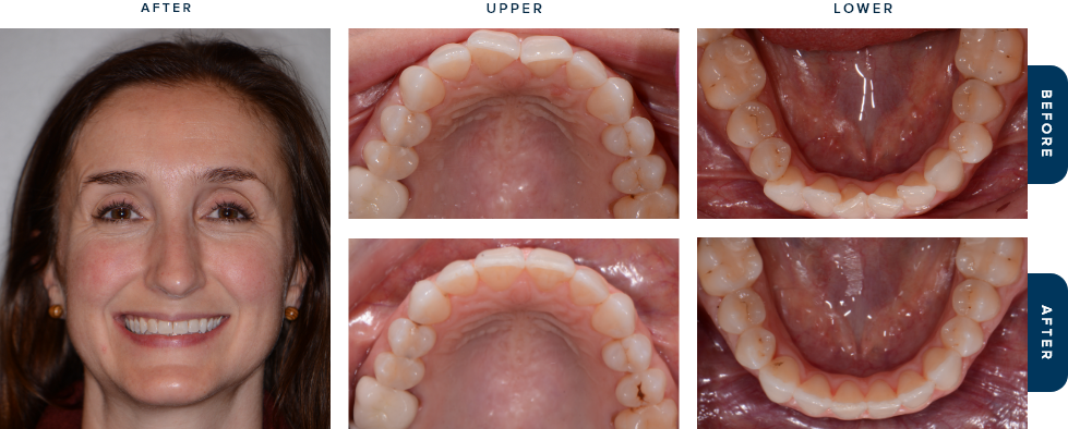 Dental patient smiling before and after Invisalign treatment in Cary