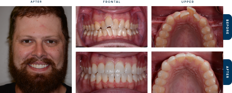 Dental patient smiling before and after Invisalign treatment