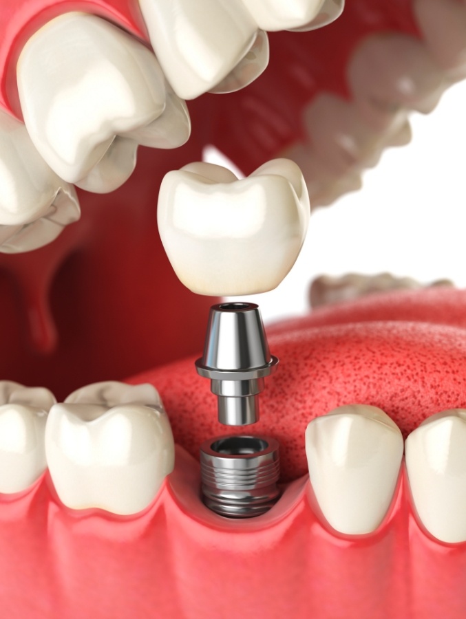 Animated dental implant replacing a missing tooth in Cary