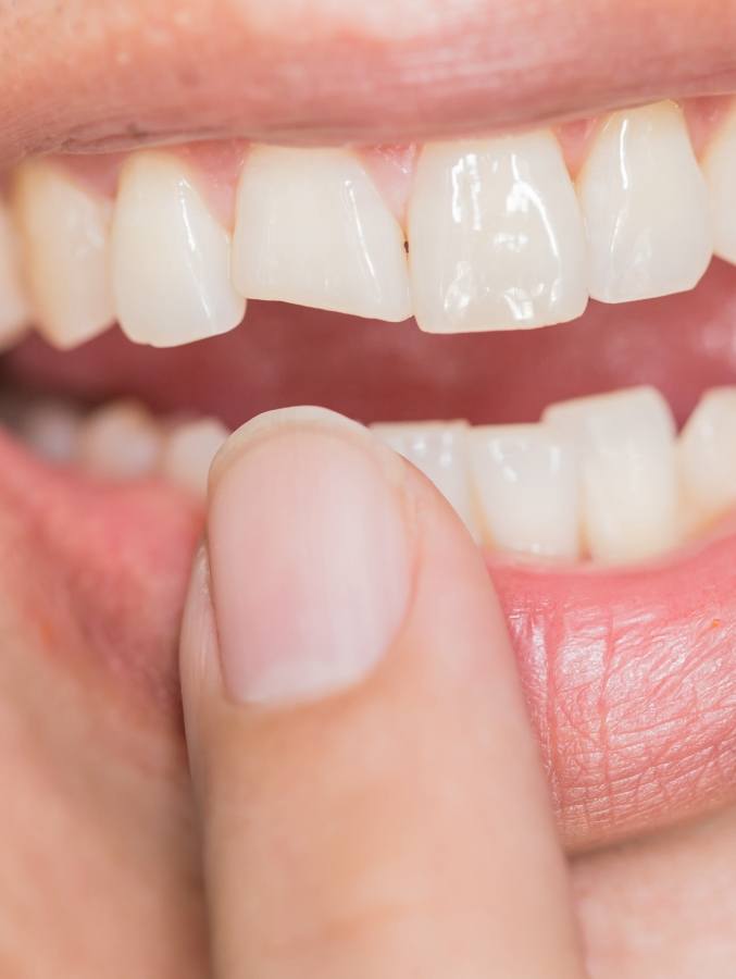 Close up of person pointing to their chipped tooth