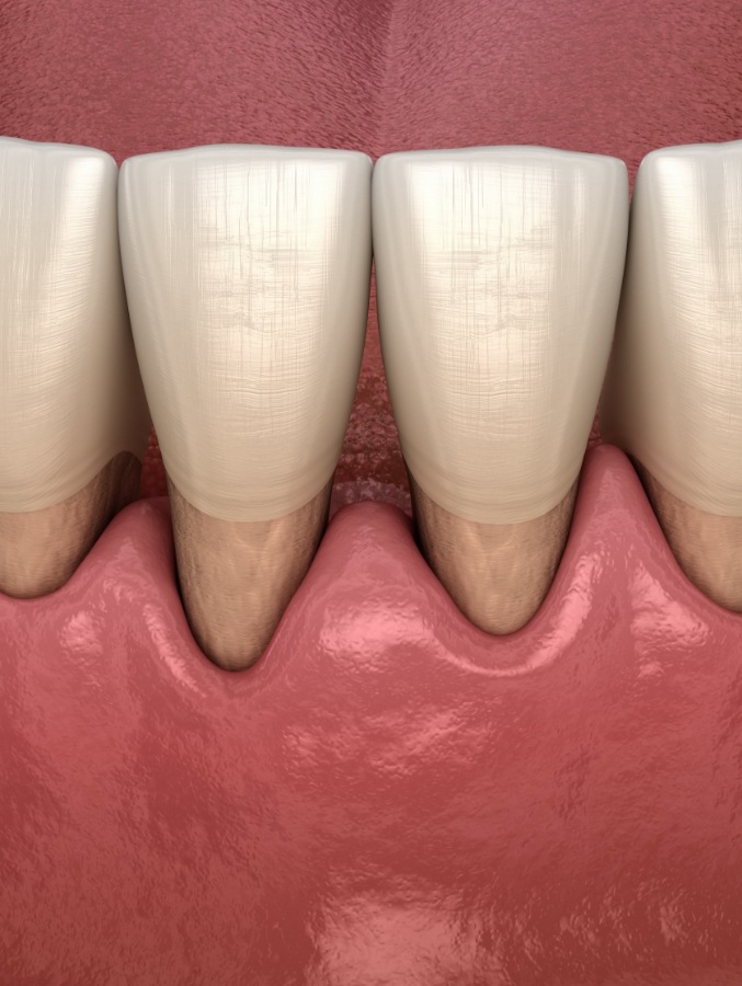 Animated teeth with receded gums that need gum disease treatment in Cary