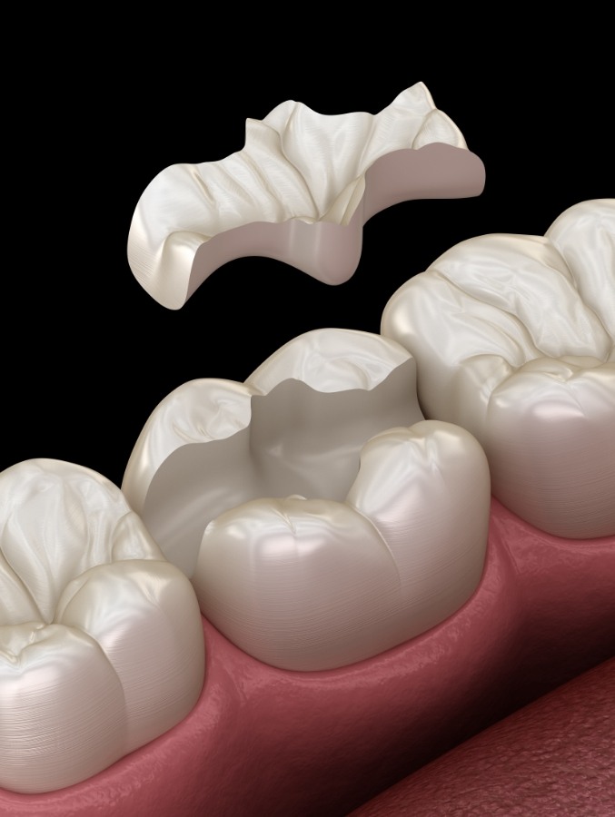 Animated tooth colored filling being placed onto a tooth