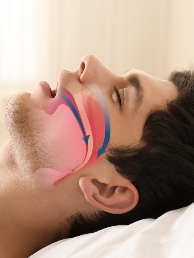 Man laying on back to sleep with animated illustration of blocked airway