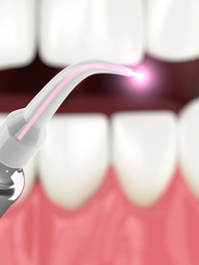 Animated dental soft tissue laser