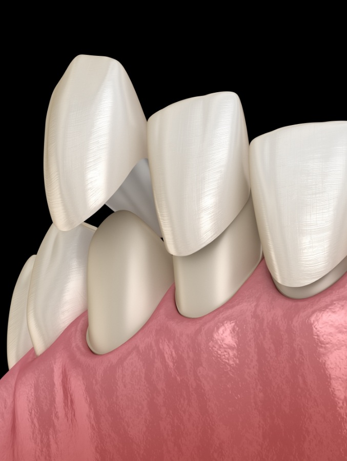 Animated veneers being placed over teeth