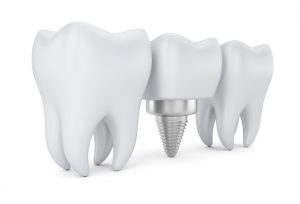 Dental implant dentist in Cary for a complete smile.