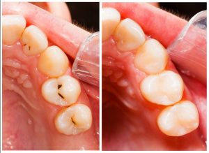 tooth-colored fillings