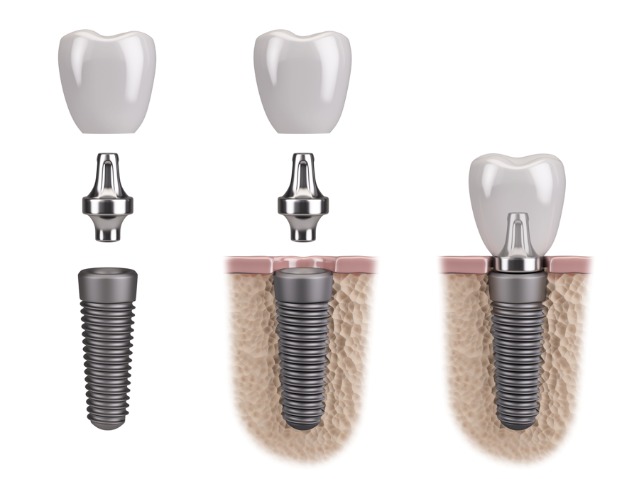 Implant, abutment, and crown