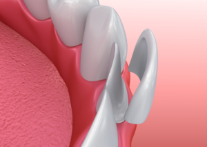 Porcelain veneer in front of a tooth.