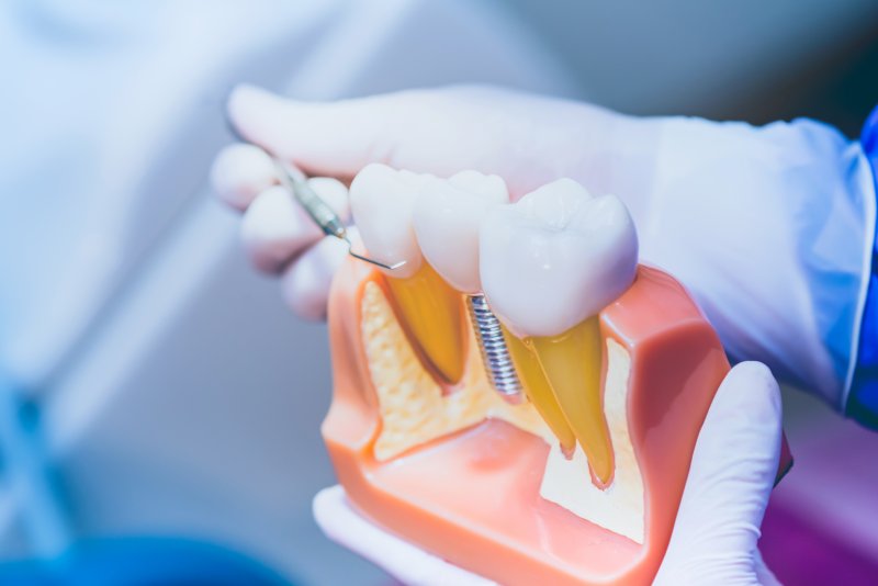 a dentist holds a cross-section of a mouth mold and points to the dental implant located between two healthy teeth